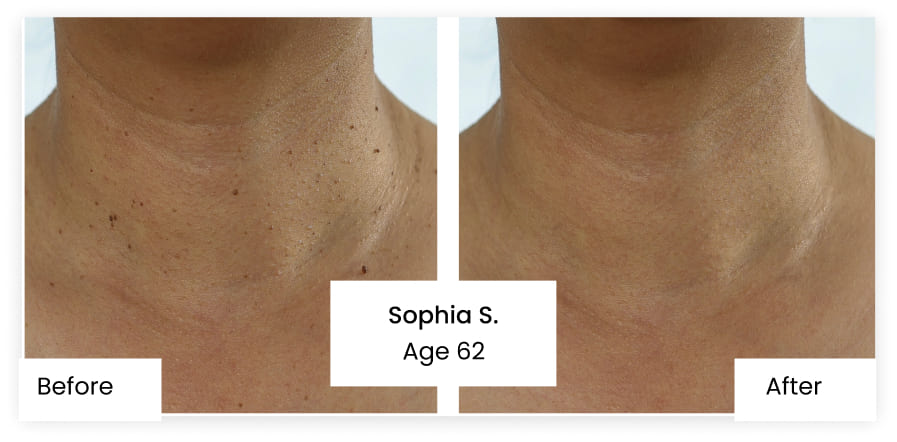 Anti Wrinkle Cream Cost